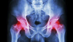 hip implant xray